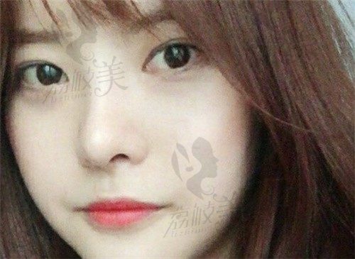 想问武汉汪福强做鼻子怎么样？来看我去美基元做鼻综合手术经历