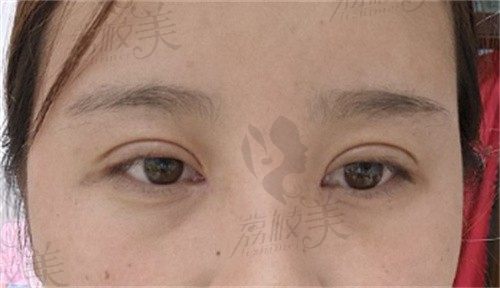 西安美莱做双眼皮真实反馈，柏国芳修复双眼皮技术确实不错