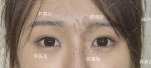 广州华美林晓燕做眼睛怎么样？从双眼皮口碑范例来看，技术真的好