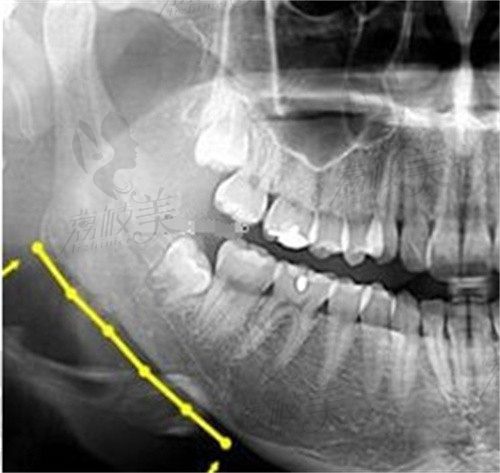 带牙套影响做下颌角手术吗?发现戴隐形/金属牙套做下颌角各有不同