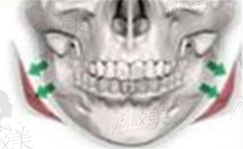 看完广州广大罗延平简介,你就知道罗延平做下颌角磨骨手术怎么样