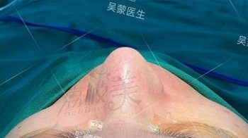 手术后