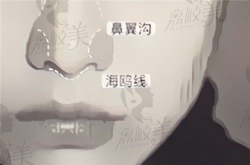 上海华美叶丽萍做鼻子价格8.2w起，半肋软骨鼻综合技术审美在线
