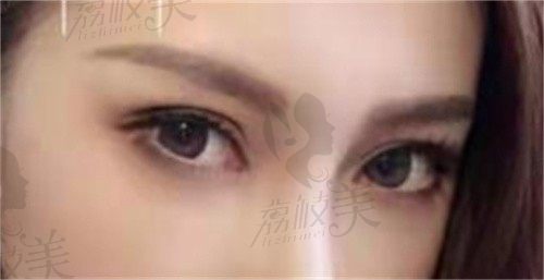 西安美赫拉医疗美容怎么样？耿向阳双眼皮整形修复做的好吗？