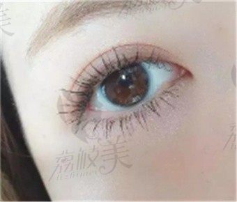 武汉江城医院做双眼皮怎么样?自然灵动的美眼综合张超医生亲诊价1万起