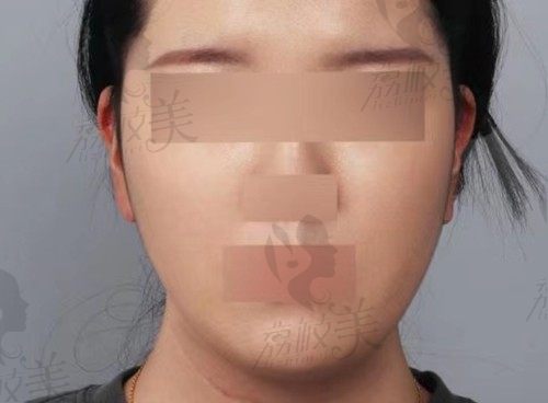 看我去韩国找俪伴的郑渊豪院长做的面部提升，大脸秒变瓜子脸