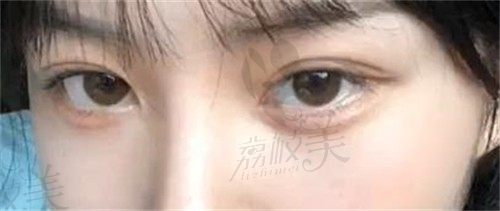 找郑州华领张永涛做的眼综合,来看我双眼皮+开眼角全程分享