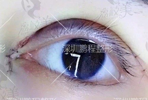 深圳王哲彗做双眼皮怎么样？看完王哲彗医生眼整形技术实力后秒懂