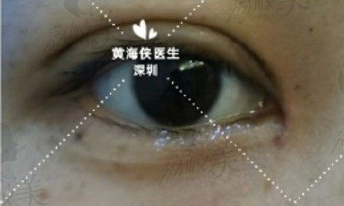 深圳黄海侠做双眼皮审美理念在线，特色美杜莎美眼术仅12800元起