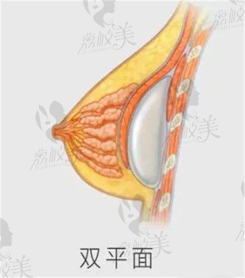 郑州东方整形医生吴振内窥镜隆胸技术成熟,微创好恢复价格划算