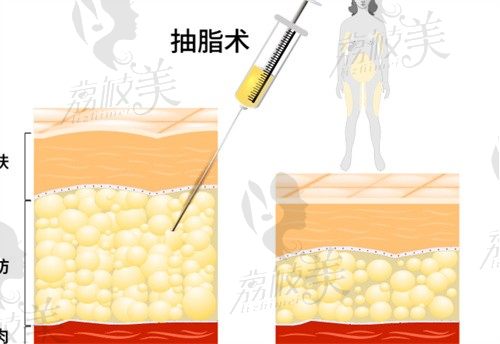 北京十大吸脂医院排名榜：联合丽格、艺星、新星靓等榜上有名