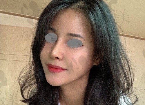 韩国百利酷整形医院做隆鼻怎么样？从我隆鼻术后看技术实例很赞