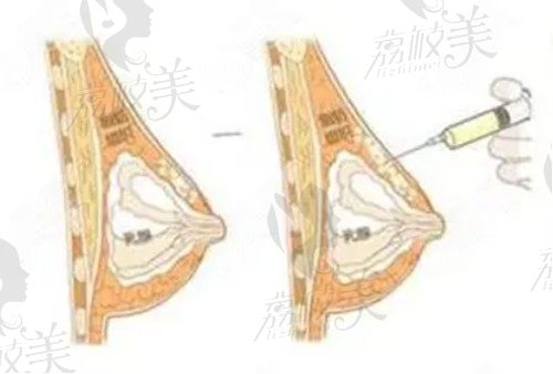 上海伊莱美和美莱哪个医院好？口碑+特色项目+资质对比看整形实力