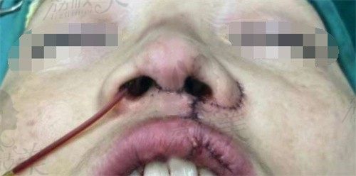 西安杨万忠医生做二期唇腭裂鼻修复实例分享，术后真的超自然