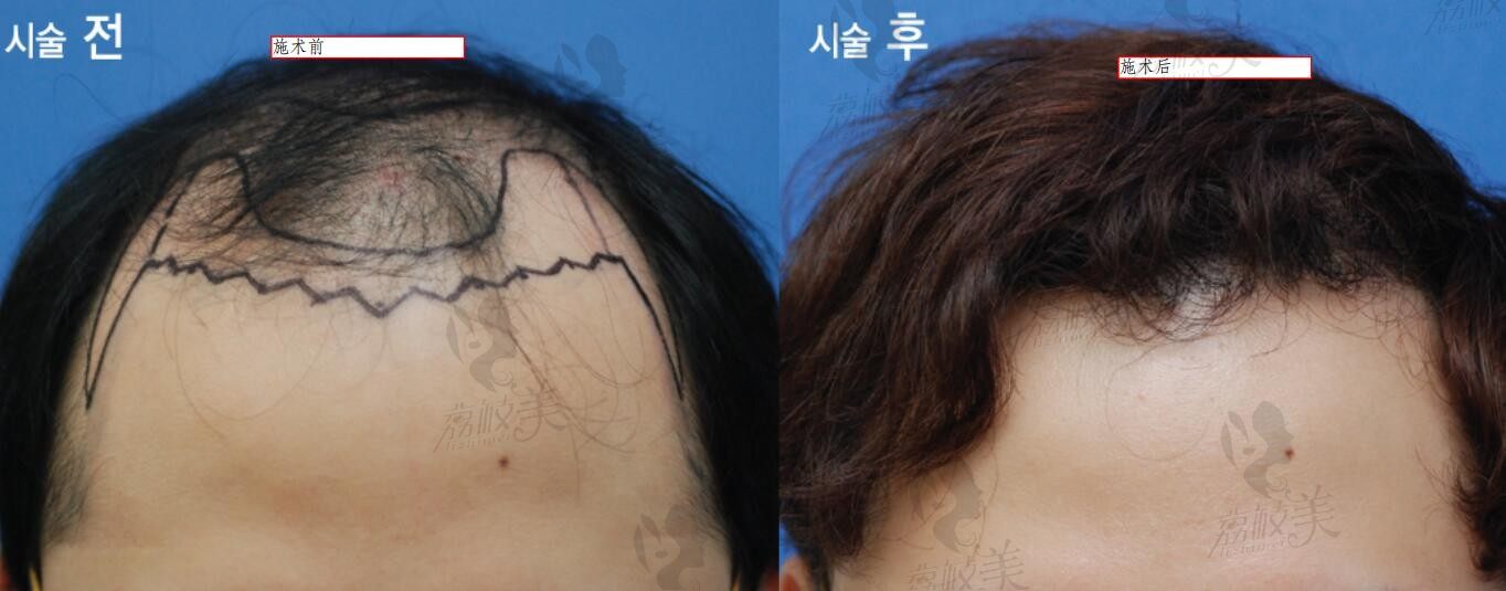 韩国布莱克毛发移植怎么样多少钱？发际线种植600万(韩币)起。