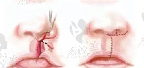 韓國唇腭裂整形醫(yī)院哪家好？送你唇腭裂修復(fù)好的排行前三醫(yī)院名單