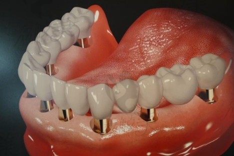 问南京全口种植牙一般要多少钱？先得了解南京哪家医院种植牙技术好