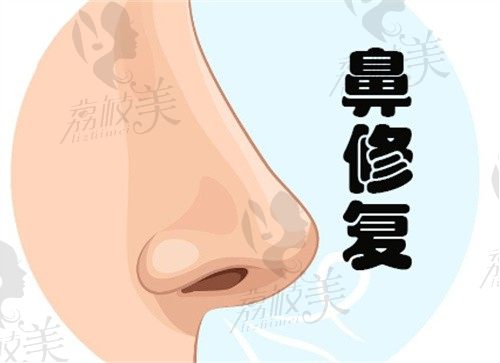 杭州维多利亚唐红伟做鼻子技术好，肋骨鼻综合修复价格仅需2万起