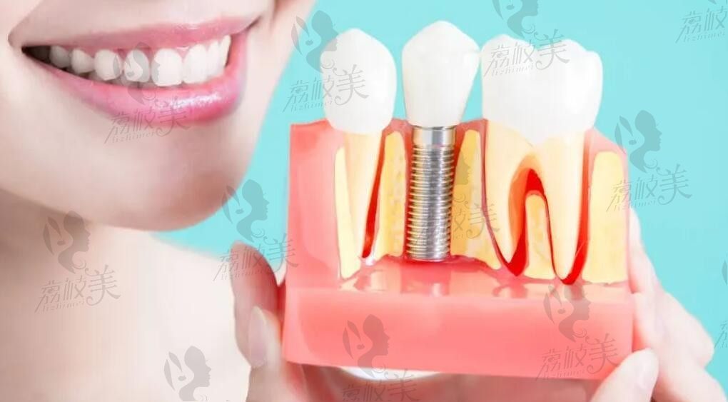分享种植牙的真实感受，带你了解一下种植牙的过程及费用是多少呢