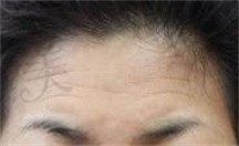 别说韩国赫拉整形额头提升做挺好,川字纹眼皮下垂改善大显年轻！