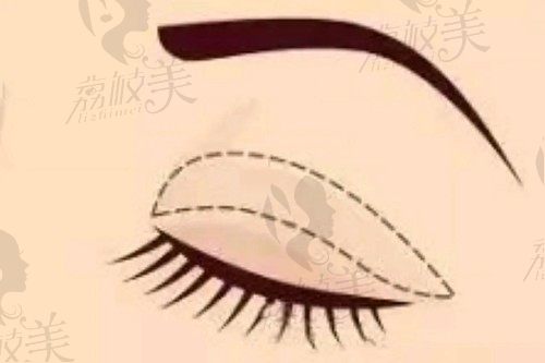 上海美莱何祥龙做双眼皮怎么样？做眼部综合技术水平高起价18800元