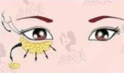 上海美莱何祥龙口碑技术佳，外切去眼袋能改善眼周问题价格13880元起