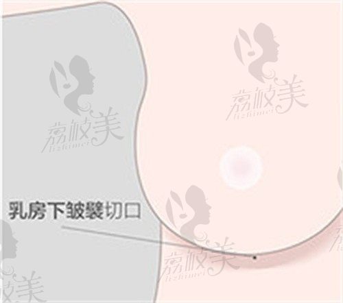 杭州美莱栗勇隆胸价格5万起，双平面假体植入术后胸型饱满自然