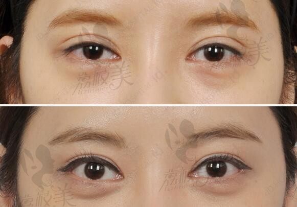 2023年度韩国高难度眼修复医院推出，韩国修复双眼皮厉害的医生都在这里