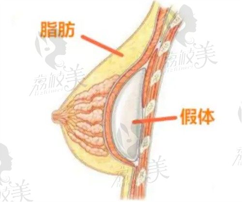 西安画美赵敬国医生隆胸技术可靠，假体+脂肪复合隆胸价格仅3万起
