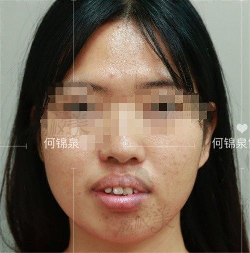 广州何锦泉做正颌手术有名，起价5万改善牙骨突出脸部不对称