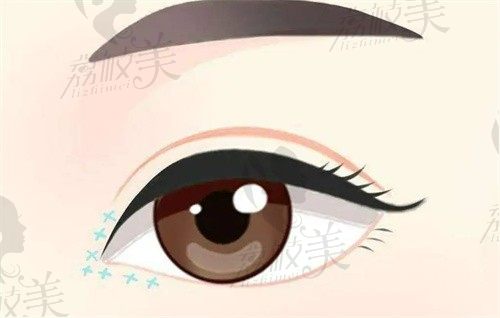 厦门海峡双眼皮做得好，王阳明医生做眼综合塑造美眼2.8w起