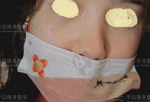 深圳宝丽李信锋做鼻修复技术杠杠的，术后愣是一点痕迹都没有