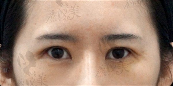 韩国双眼皮手术价格不贵的，我在优雅人做了眼睛花了17000多块