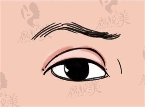 西安孙峰双眼皮修复实例多口碑好，眼修复技术审美在线价格14800元起