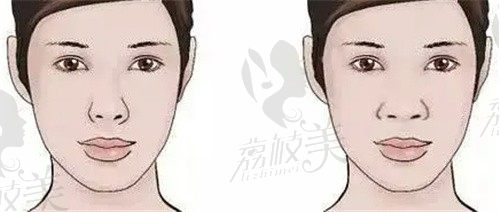 武汉江城王志做的鼻子非常漂亮，改善了我多年的塌鼻子大鼻头