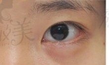 手术后