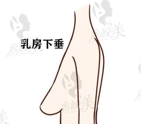 杭州美莱栗勇做胸部下垂矫正价格5万起，乳房下垂上提术后自然饱满