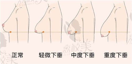武汉五洲余成坤隆胸修复经验技术都不错，乳房缩小手术也只要5W起