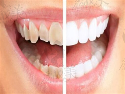 牙齿贴面的操作流程有哪些？粘贴过程中有什么要注意的吗