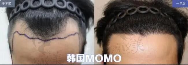 韩国植发技术怎么样？韩国植发非切开和切开式区别和适应症分析