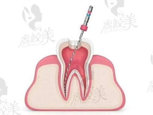 为什么良心医生不建议做根管治疗？深龋直接拔掉好还是做根管治疗好？