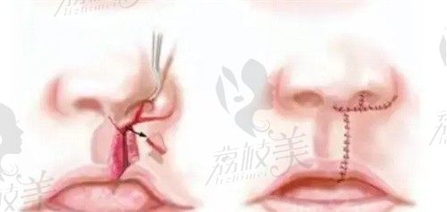 上海时光宋茂启唇腭裂修复怎么样？二期修复治疗兔唇价格2.9w起