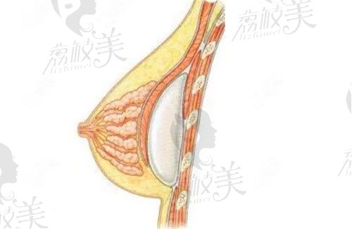 查询上海隆胸修复术多少钱？上海时光李静林做胸修复起价6.3w元