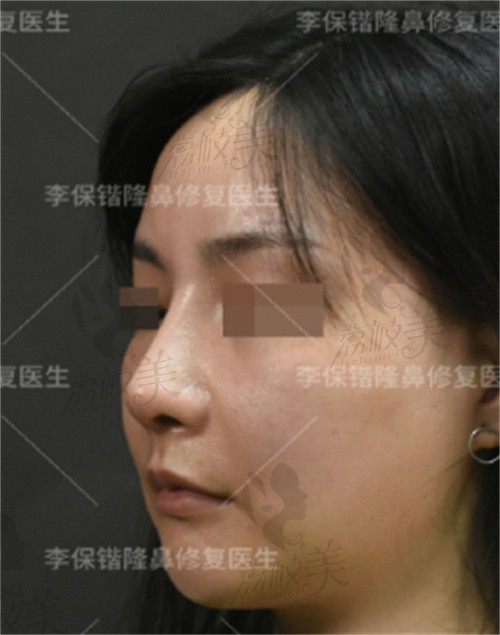 杭州李保锴肋骨鼻综合修复技术赞，鼻头挛缩修复好后成功拥有幼态鼻