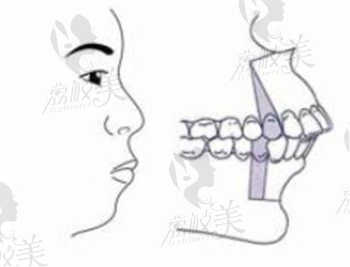 广州柳超医生做正颌手术技术好，骨性龅牙地包天矫正价格5万起