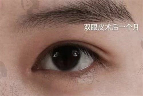 有谁找过上海美莱吴海龙做双眼皮？我做眼综合一个月对比照发你