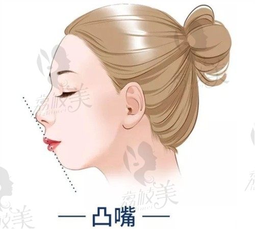 上海何晋龙正颌手术口碑好，8万起单颌+颏成型改善凸嘴矫正脸型