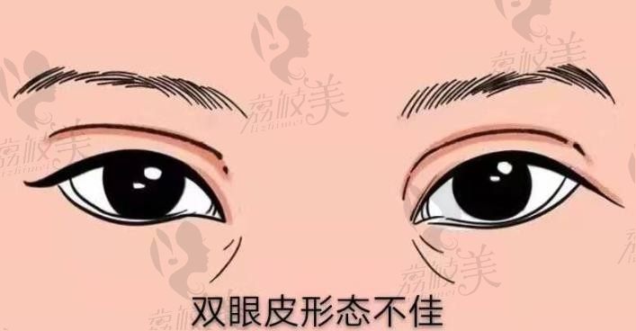福州周秀峰院长双眼皮修复1.4w元起，全眼定制恢复双眼自然无痕状态