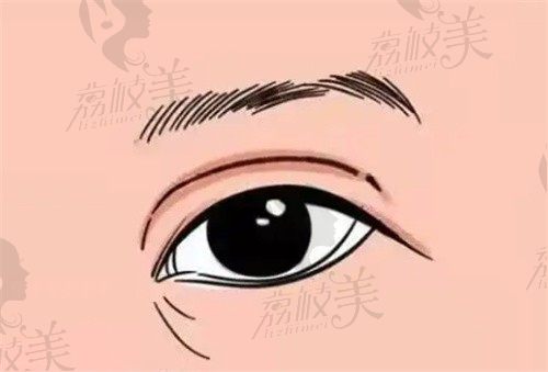邓东伟双眼皮修复价格5.5w起，眼部全切修复改善过宽/线条不流畅
