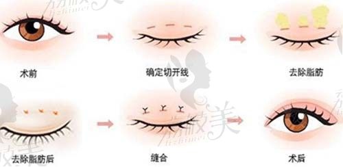 武汉双眼皮修复医院排行榜上，这几家医院有眼整形口碑好的医生